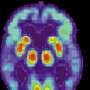 Alzheimer’s may have once spread from person to person, but the risk of that happening today is incredibly low